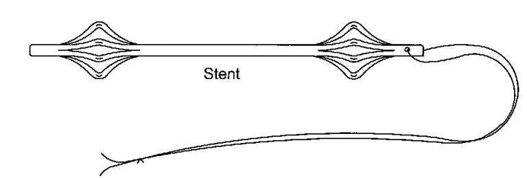 PS - Prostatický Stent